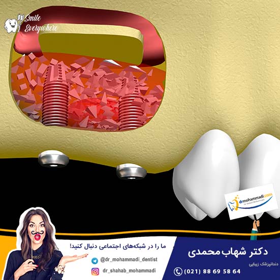 پودر استخوان bottis چه تاثیری در موفقیت کاشت ایمپلنت دندان دارد؟ - کلینیک دندانپزشکی دکتر شهاب محمدی